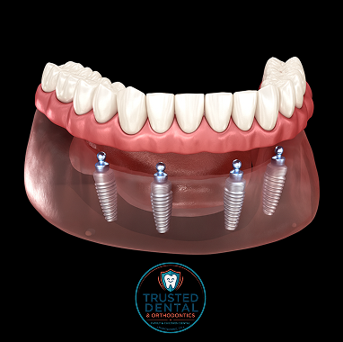 Snap-On Implant Dentures