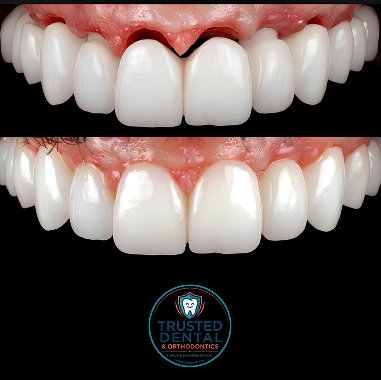 FP1 Natural Smile Approach